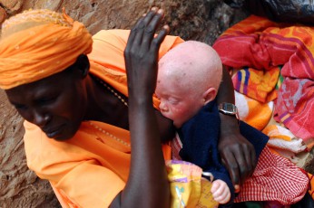 1jpg Burundi, the hunting of albinos people, victims of ignorance.